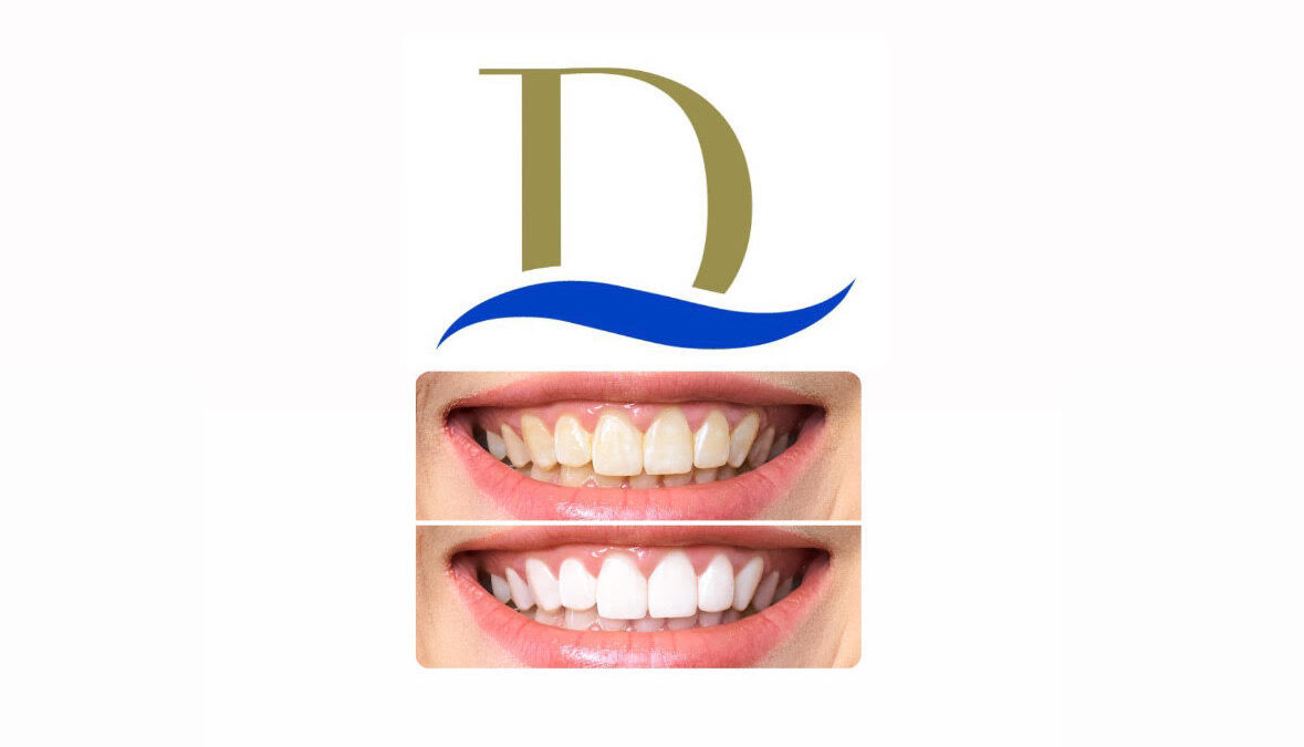 مركز دلما الطبي يطلق عرضًا خاصاً لتبييض الأسنان